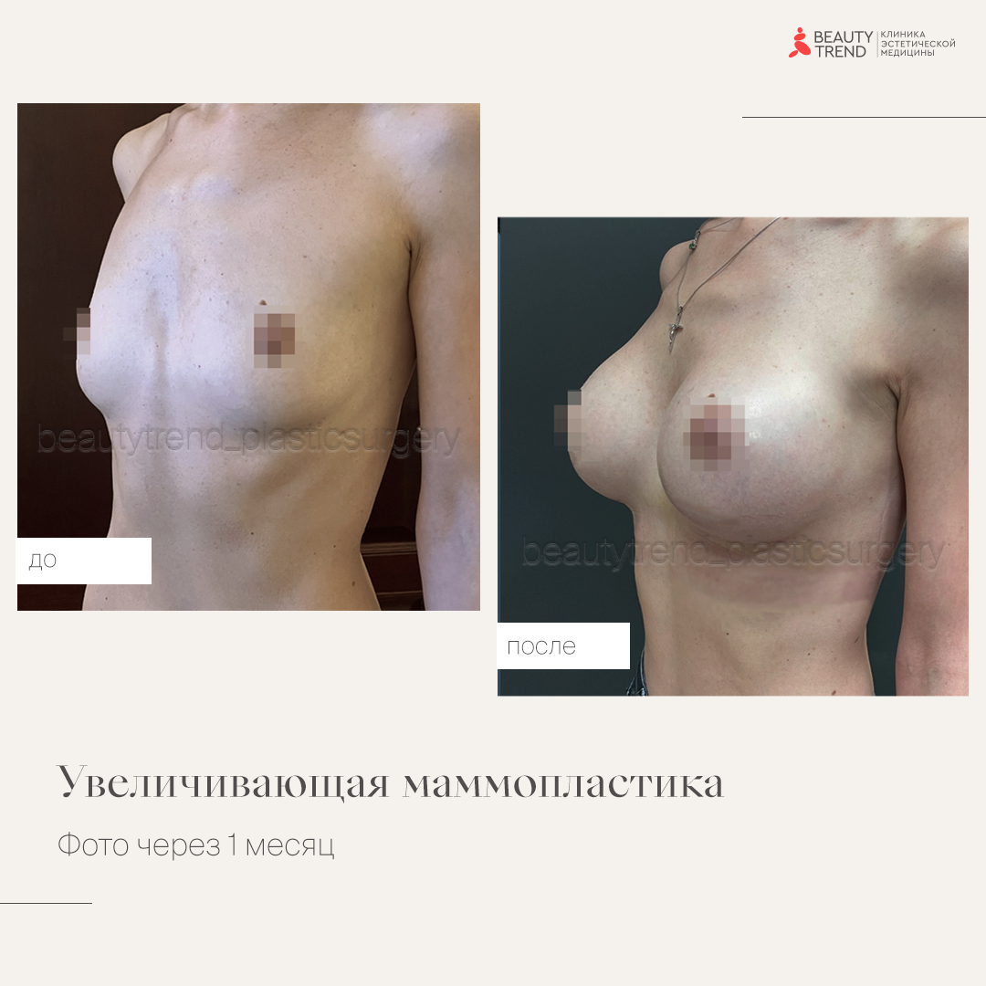 Увеличение груди имплантами, 3А - 1